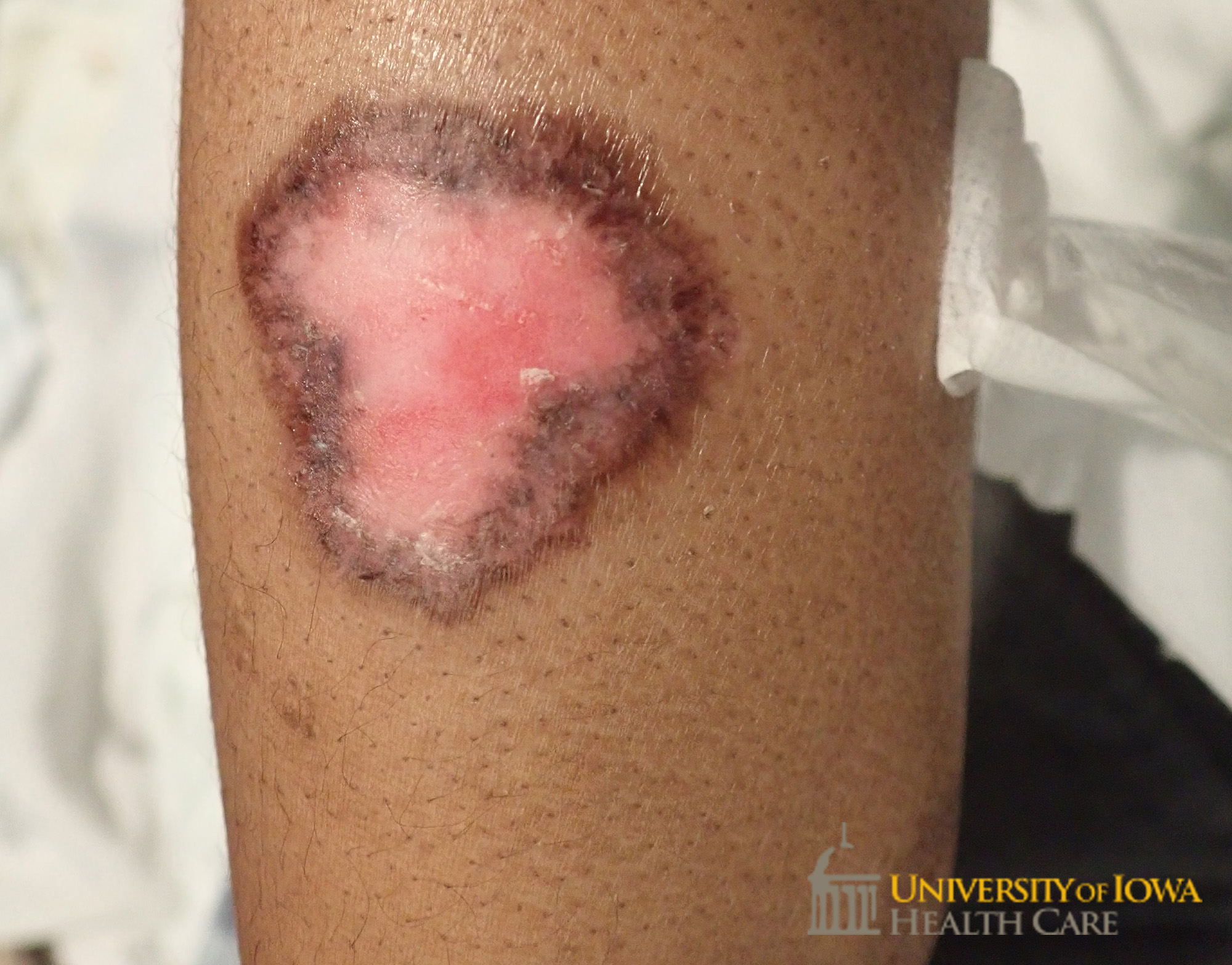 Well-demarcated shiny, atrophic plaques with central depigmentation and peripheral hyperpigmentation on the extremity. (click images for higher resolution).